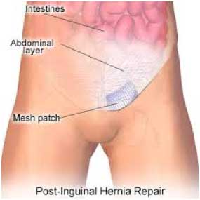 Post Inguinal Hernia Repair