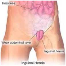 Inguinal Hernia Removal St. George Surgical Center