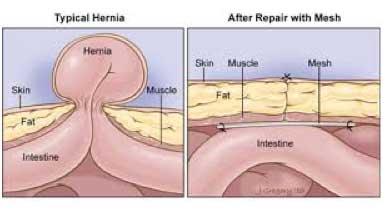 Hernia before & after repair