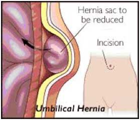 Umbilical hernia repair - NHS