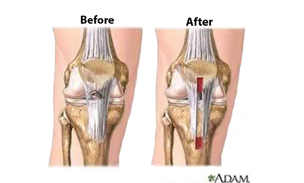 Anterior Cruciate Ligament (ACL) Reconstruction with Allograft (Includes  Implants & Hardware) – St. George Surgical Center