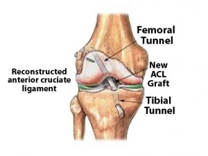 ACL-Reconstructed