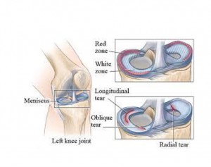 Arthroscopic-Meniscus