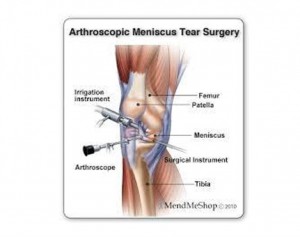 Arthroscopic-Meniscus-Tear-Surgery