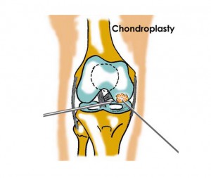 Chondroplasty