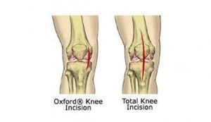 Incision-Oxford-Comparison