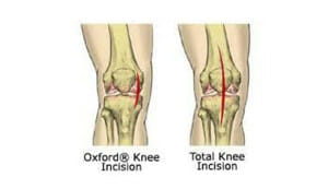 Knee Surgery incision comparison
