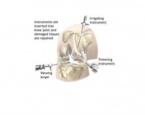 Knee-Arthroscopy-(One)