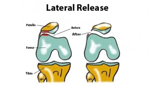 Knee-Repair-Lateral
