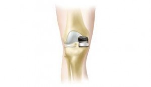 Knee-Replacement--Parial