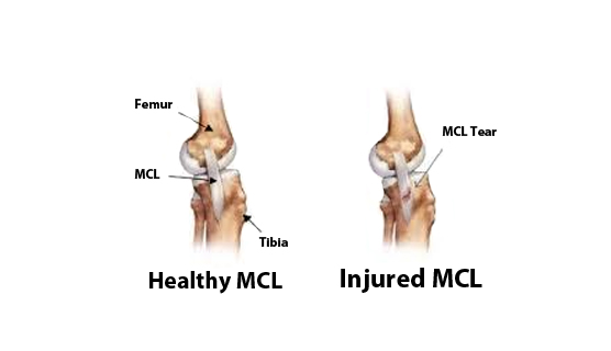 MCL Reconstruction - Knee Surgery - St. George Surgical Center