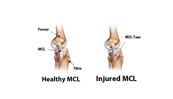 MCL Injury: Medial Collateral Ligament (MCL) Tear & Reconstruction, Knee  Surgeon in Mumbai