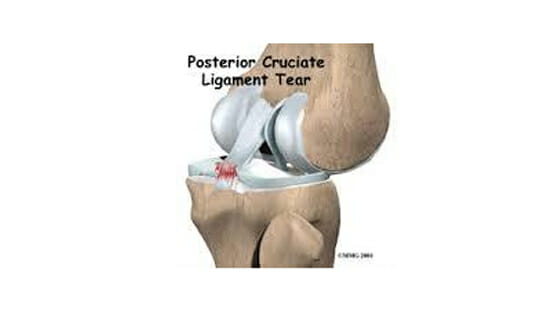 Posterior Cruciate Ligament Tear Posterior Cruciate Ligament Tear St. George Surgical Center