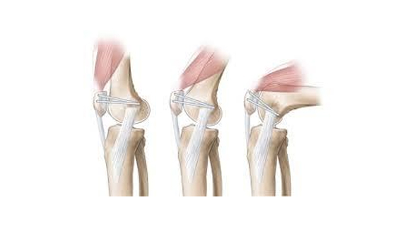 Medial Collateral ligament (MCL) Reconstruction
