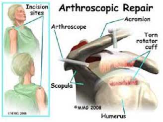 Rotator Cuff Repair - Arthroscopic - St. George Surgical Center