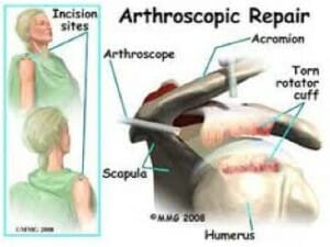 arthroscopic repair St. George Surgical Center