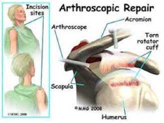 arthroscopic repair St. George Surgical Center arthroscopic repair St. George Surgical Center