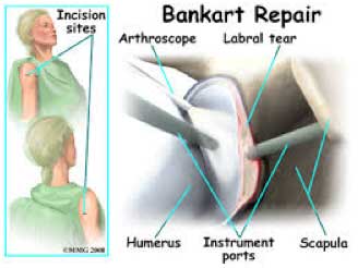 Bankart Repair St. George Surgical Center