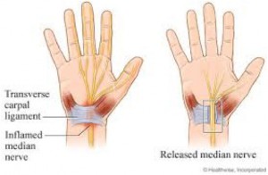 carpal-release