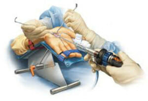 Carpal release/removal/surgery in Utah