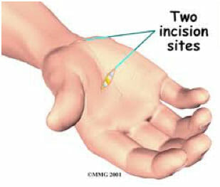 carpal surgery incisions in St. George, Utah