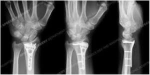 Carpal Surgery in Utah