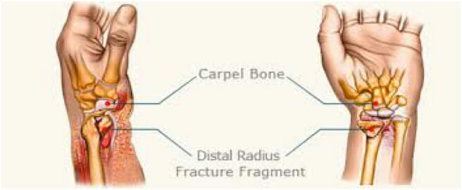 Carpal Bone