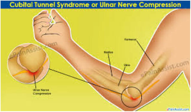 Cubital Tunnel in your arm