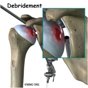 debridement