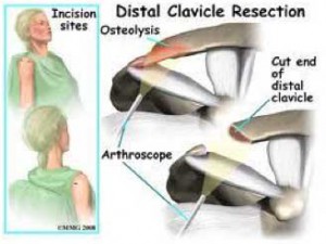 distal-clavical