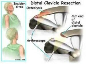 Distal Clavicle Resection