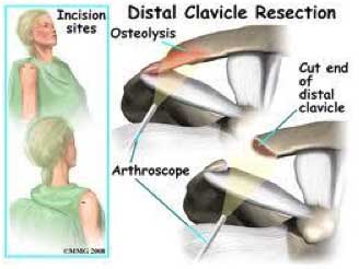 Distal Clavicle Resection