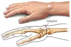 ganglion