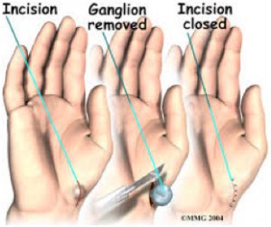 ganglion-surgery