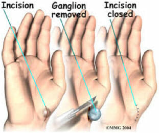 Ganglion Surgery/Removal in Utah