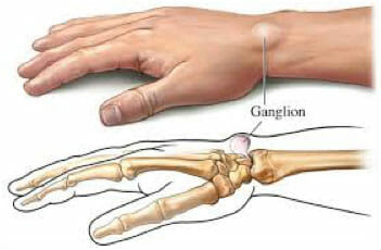 Ganglion St. George Surgical Center