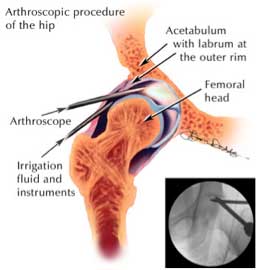 Hip Arthroscopy Utah