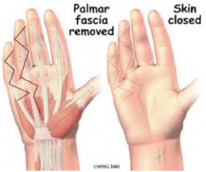 palmar-fascia