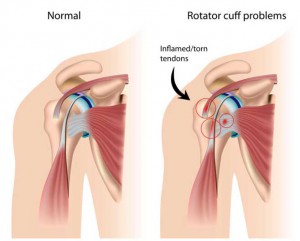 rotator-cuff