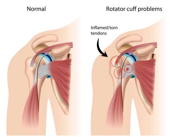 Open Rotator Cuff Repair - St. George Surgical Center