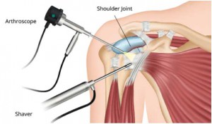 shoulder-arthroscopy