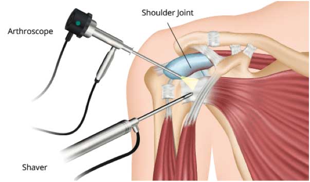 shoulder arthroscopy St. George Surgical Center