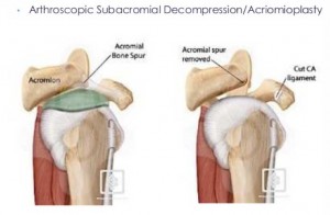 subacromial