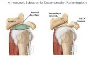 Arthroscopic Subacromial Decompression/Acriomioplasty