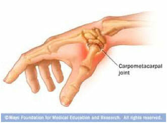 Thumb Surgery St. George Surgical Center
