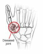 Thumb Surgery in Utah