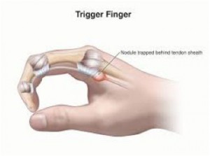 trigger-finger