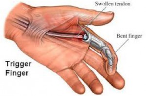 trigger-finger-repair