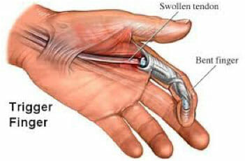 Trigger finger repair Utah