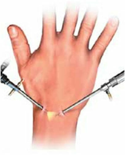 Wrist Surgery in Utah